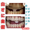 比較「別人級に白い歯に」