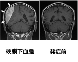 硬膜下血腫が脳を圧迫しており、様々な症状の発生が予想されます「三次神経内科クリニック花の里」