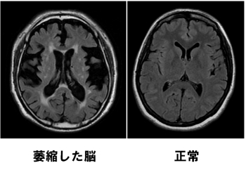 脳萎縮や脳虚血などMRIによって頭の中の状態を確認できます「ビハーラ花の里病院」