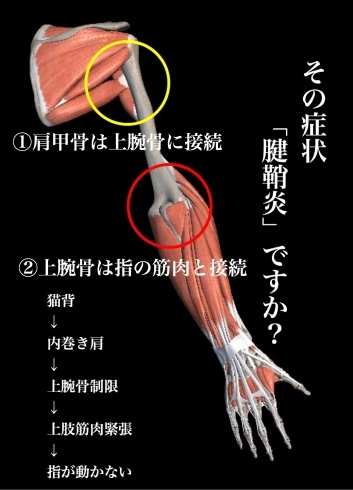 「指の痛み。本当に「腱鞘炎」ですか？」