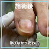 お爪再生コースの８か月後　No.103-4「お爪再生コースの８か月後」