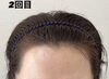 スカルプタトゥー「薄毛ケア」