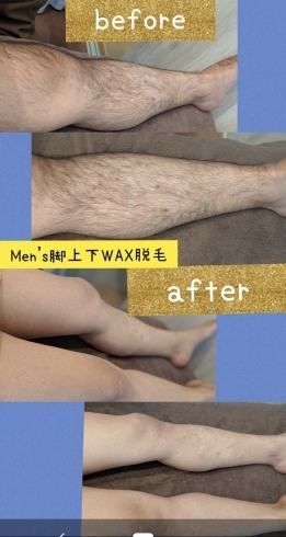 メンズ脚上下Wax脱毛before after「メンズワックス脱毛before after」