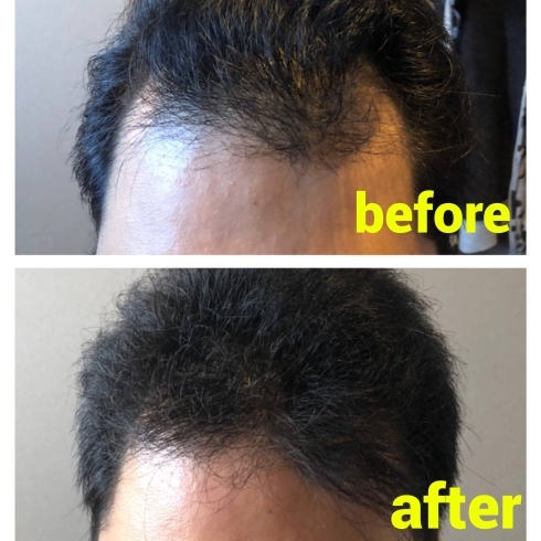 3カ月の結果です「頭髪再生‼️」