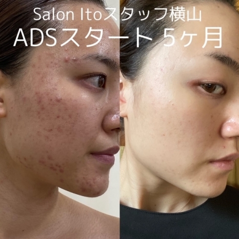 肌改善☆ドクターリセラADSシリーズ化粧品‼ | Salon Ito（サロンイトウ