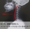 慢性の肩こりや頭痛 ストレートネックが原因かも カイロプラクティックみっきーのニュース まいぷれ 小樽市