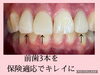 保険適応の前歯です「保険適応でもこんなにキレイに」