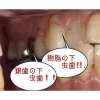 銀歯の下の、樹脂の下の むし歯「かぶせ物をしても虫歯になるの? なるよ!」