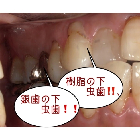 銀歯の下の、樹脂の下の　むし歯「かぶせ物をしても虫歯になるの？　なるよ！」
