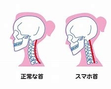 スマホ首「スマートフォン症候群【日吉駅徒歩3分の接骨院】」