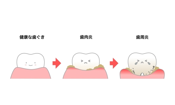 「糖尿病と歯周病の深い関係！」