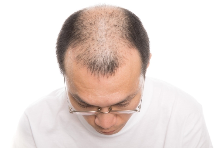 「【加古川AGA】AGA（男性型脱毛症）で悩んでいます。頭皮の状態が大切だと聞いたのですが、どんな頭皮が良いのでしょうか？」