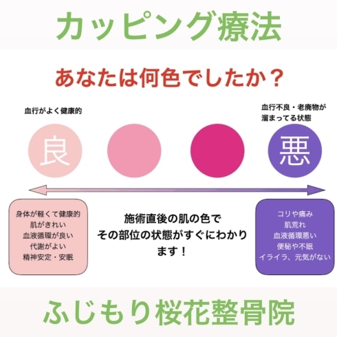 「カッピング療法は八王子のふじもり桜花整骨院　吸玉　ばっかん　治療　施術　交通事故対応院　筋膜リリース　骨膜リリース　ストレッチ　スポーツ整体　マッサージ　鍼　お灸　」