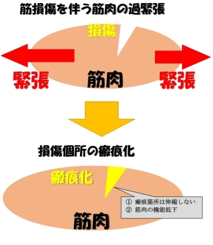 筋損傷と瘢痕化「痛めた筋肉のその後」