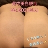 「背中美白脱毛！人気沸騰中✨」