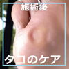 たこのケア事例No.84写真４「【硬い芯をごっそり取ります！たこのケア事例No.84】」