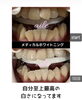 メディカルホワイトニング「メディカルホワイトニング」
