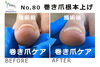 N80.巻き爪根本上げの施術事例３「N80.巻き爪根本上げの施術事例」