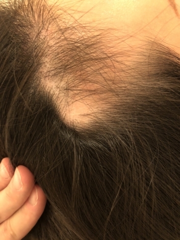 ビフォー「薄毛治療、円形脱毛症の治療」