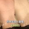 「夏は背中まで綺麗に♡♡背中脱毛で美白もゲット！背中脱毛...￥8800」