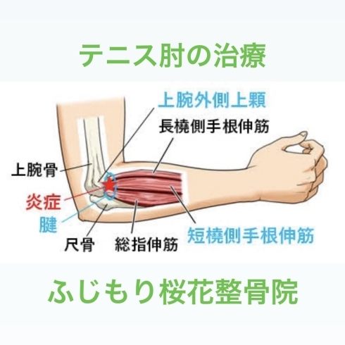 「テニス肘の治療｜ふじもり桜花整骨院、交通事故専門治療院、鍼灸師募集、小顔矯正、労災保険治療、加圧トレーニングパーソナル、枕診断テスト、フットケア、脱毛サロン、痩身エステ、ダイエット、フェイシャルエステ」