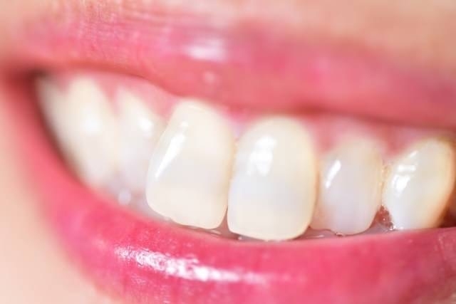 「保険を使って白い歯を被せる#福岡県大野城市#歯医者#口コミ」
