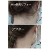 脱毛「まつ毛エクステ、脳洗浄、プラズマ、フォトフェイシャル超人気です＼(^o^)／」