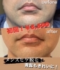 「青髭対策！ヒゲ脱毛！...✨初回￥5,500✨」