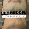 「青髭は、さようなら。【ヒゲ脱毛】￥5,500  《お試し価格》」