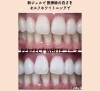 歯のセルフホワイトニング 医療級の歯の白さ」を目指せます✨ | WHITENING CARE（ホワイトニング