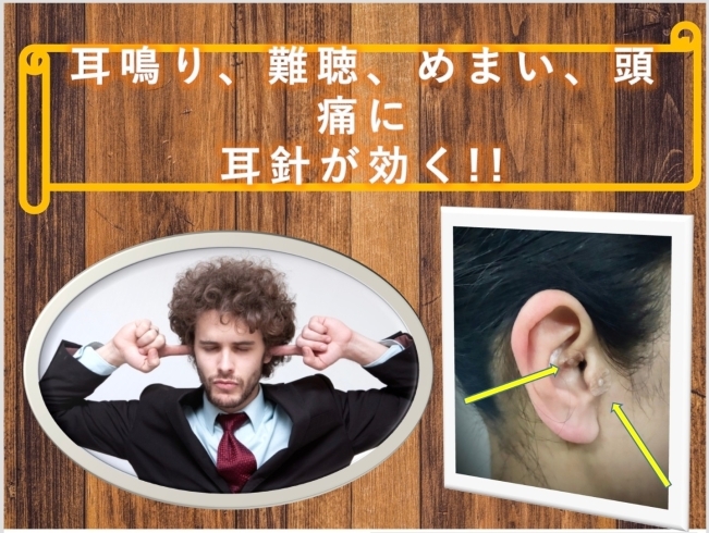 耳針は、目立たない肌色テープ「耳鳴り、難聴、めまい、頭痛に耳針が効く。【習志野駅近の鍼灸整体治療院　身体の痛みや、長年の身体の不調に悩まされている方に】」