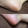 かかとツルツル＼(^o^)／「ガサガサかかと！990円でツルツルに！」