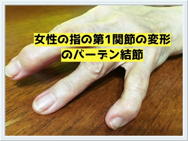へバーデン結節「女性の指の第1関節の痛みはへバーデン結節です。」