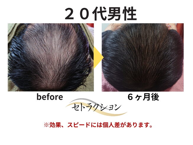 ビフォーアフター「髪の毛が日に日に薄くなり、ばあちゃんに泣きながら心配された20代男性」