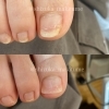 施術当日before→after「手術しなくても大丈夫な巻き爪さんが殆ど！【爪Labo】福山駅前/爪のお悩み専門サロン/巻き爪/肥厚爪/陥入爪/自爪育成」
