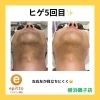 【清潔感•印象UP】磯子のヒゲ脱毛ならエピット
