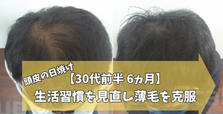 30代男性発毛症例「【30代男性】日焼けの薄毛も6ヵ月改善」