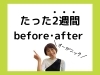 次の画像へ→✨「30代女性 眉間の毛穴でお悩み🌀」