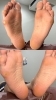 ビフォー＆アフター「足裏タコに長年悩んでる方‼️是非🦶」