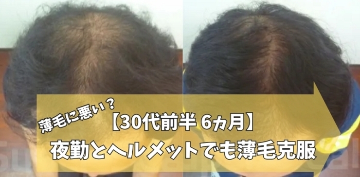 30代男性AGA薄毛改善症例「【30代男性】夜勤とヘルメットのWパンチも6ヵ月で発毛！」