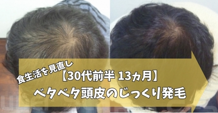 30代男性AGA薄毛改善症例「【30代男性】ベタベタ頭皮改善で薄毛克服」