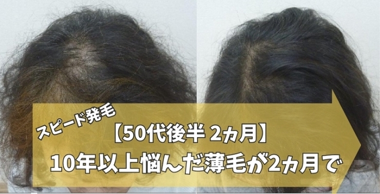 50代女性薄毛改善症例「【50代女性】10年以上悩んだ薄毛が2ヵ月で改善!!」