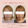 お顔が小さく✨　⁡1回のご体験でも、⁡ ⁡お顔のスッキリ感！