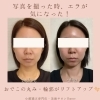 「⁡エラ中心にしっかり施術♪」