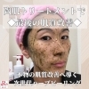 「クリニック行かずに水光肌が手に入る！本物の肌質改善へ導く次世代ハーブピーリング【那須塩原】」