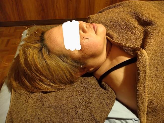 顔のむくみや目の疲れに効果的「お顔の鍼治療」