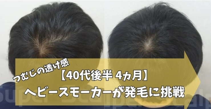 40代男性AGA薄毛改善症例「【40代男性】ヘビースモーカー4ヵ月で薄毛改善」