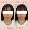 エラがお悩みとご来店された⁡お客様の変化　福井エステサロン/小顔矯正