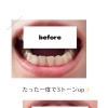 【セルフホワイトニング】ビフォーアフター！