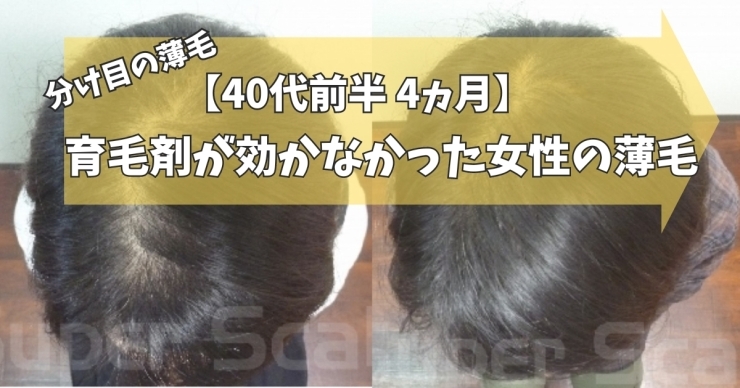 40代女性分け目の薄毛改善症例「【40代女性】育毛剤を使っても改善しない分け目の薄毛が4ヵ月で改善」